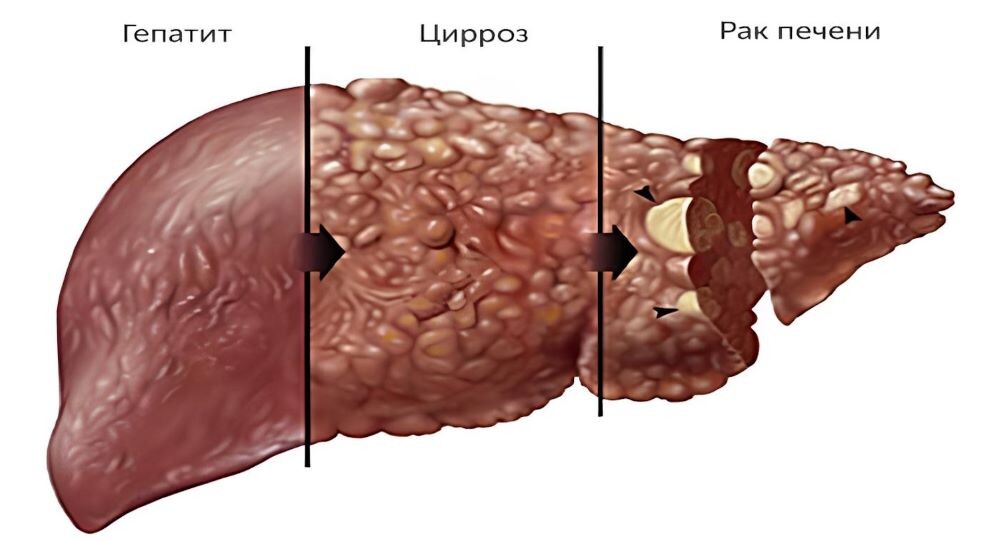 Гепатит и цирроз печени: что нужно знать